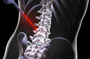 رفع فشار دیسک از روی نخاع از طریق لیزر