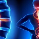 جراحی ستون فقرات با لیزر در مقابل جراحی سنتی: کدام بهتر است؟