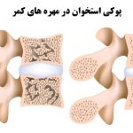 تزریق سیمان به مهره ها چگونه انجام میگیرد